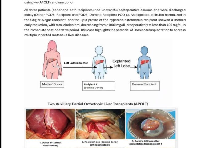 One Act of Donation, Double the Hope: A Remarkable Domino Liver Transplant at PKLI